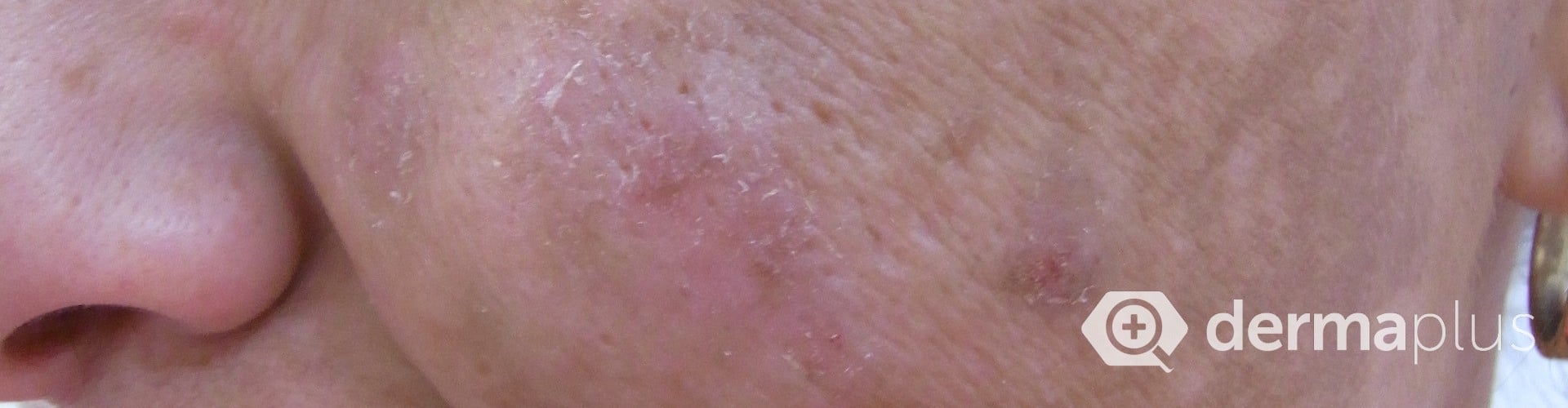 Schwangerschaftsflecken Melasma Ursachen Therapie Derma Plus