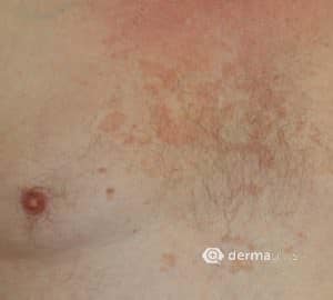 Seborrhoisches Ekzem im Brustbereich seborrhoische Dermatitis