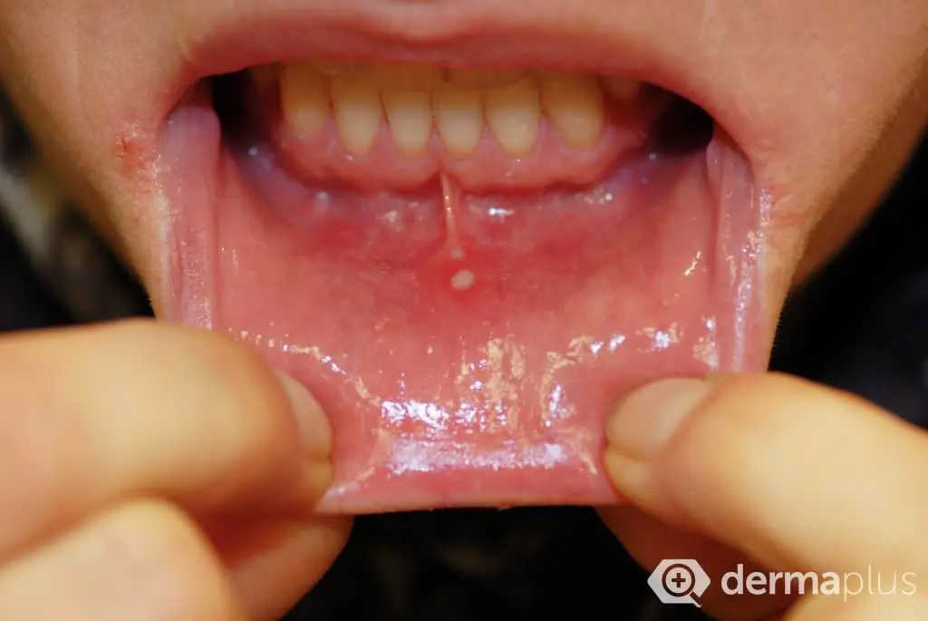 Apthen Symptome Aphten Mund Bläschen im Mund