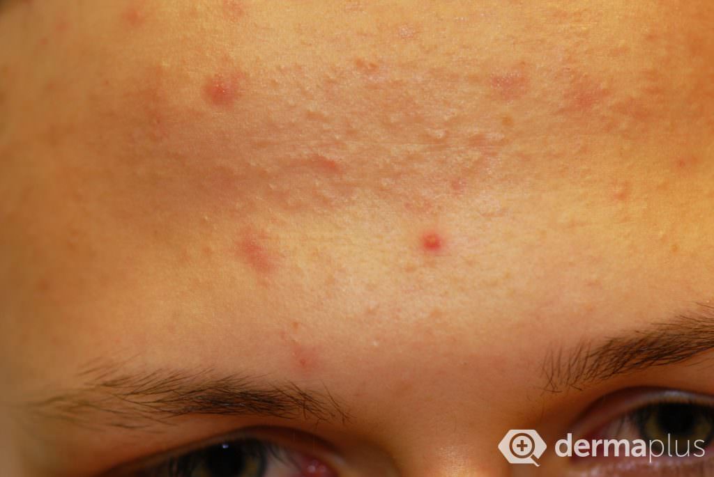 akne acne vulgaris komedonen