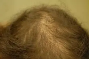 Androgenetische Alopezie Haarausfall