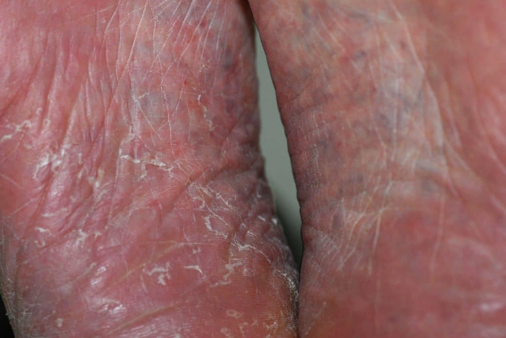 tinea pedis Fußpilz unter den Fuessen