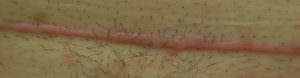cicatrix keloide narben