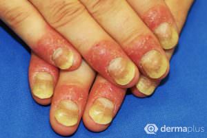 Psoriasis unguium schuppenflechte