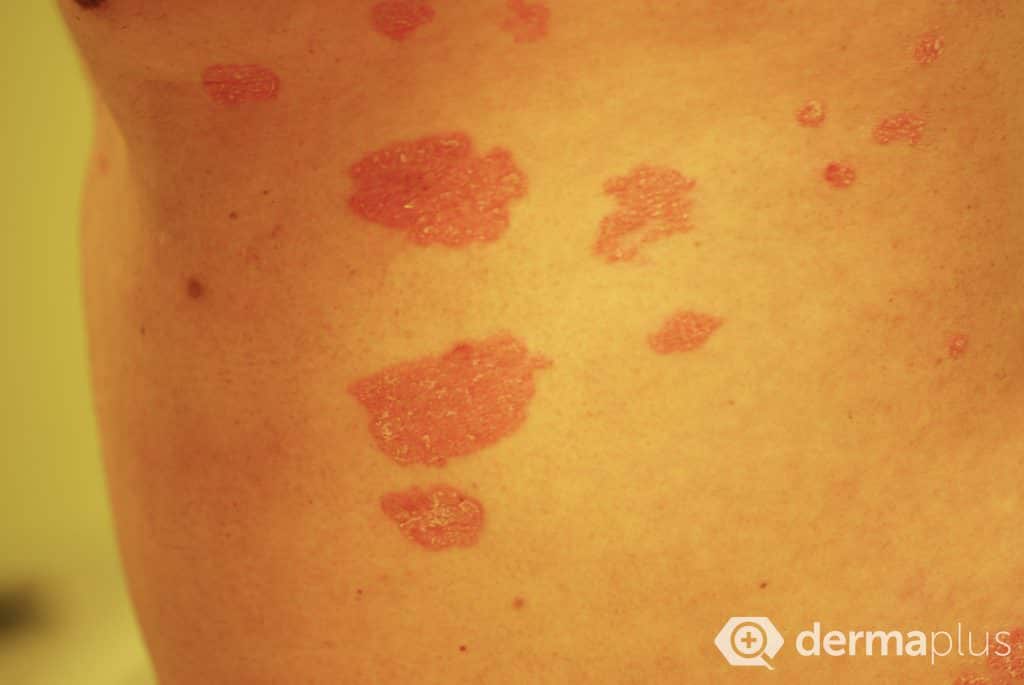 Schuppenflechte (Psoriasis) - Ursachen & Therapie | Derma.plus