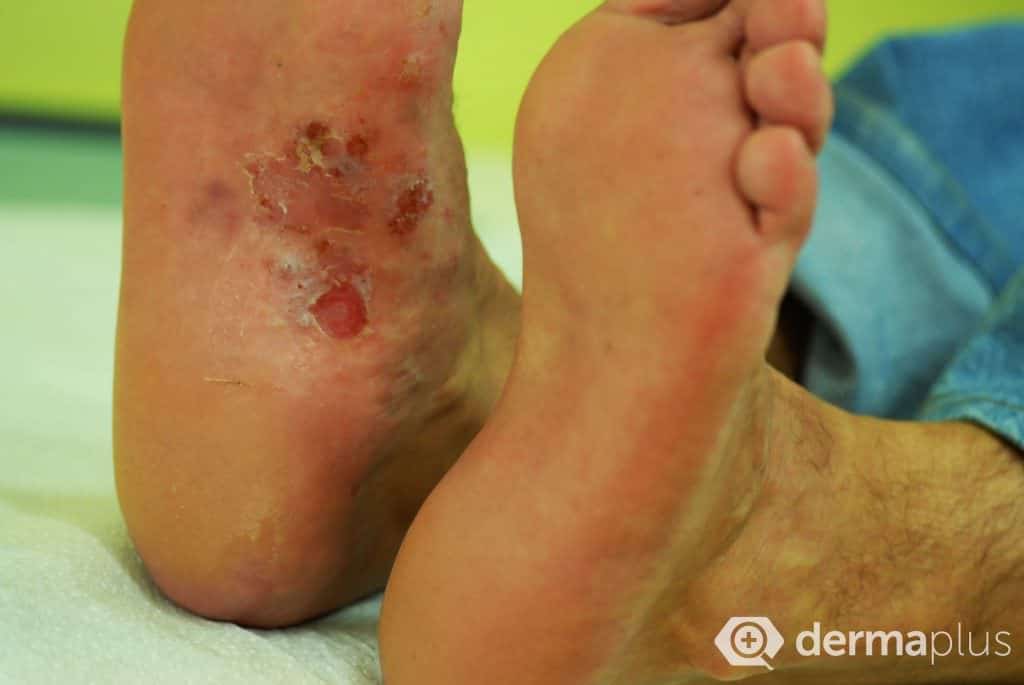 Schwerer Fußpilz Tinea pedis