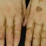 vitiligo finger