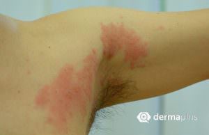 Herpes Zoster Oberarm Gürtelrose