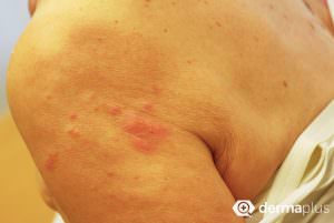gürtelrose herpes zoster Schulter