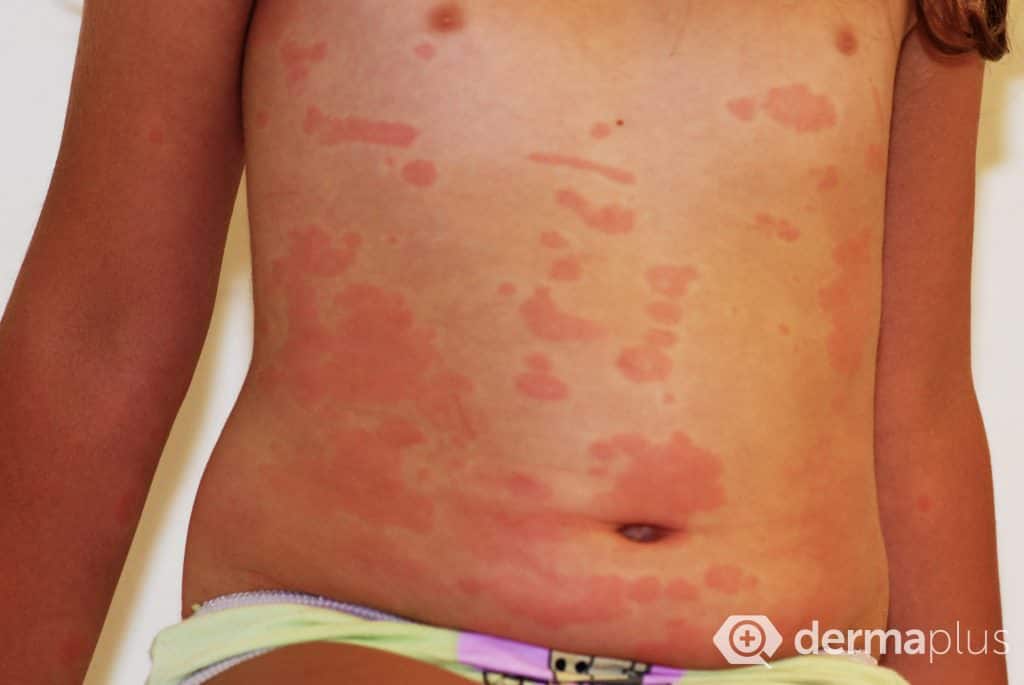 Nesselsucht (Urtikaria) - Ursachen und Therapie | derma.plus
