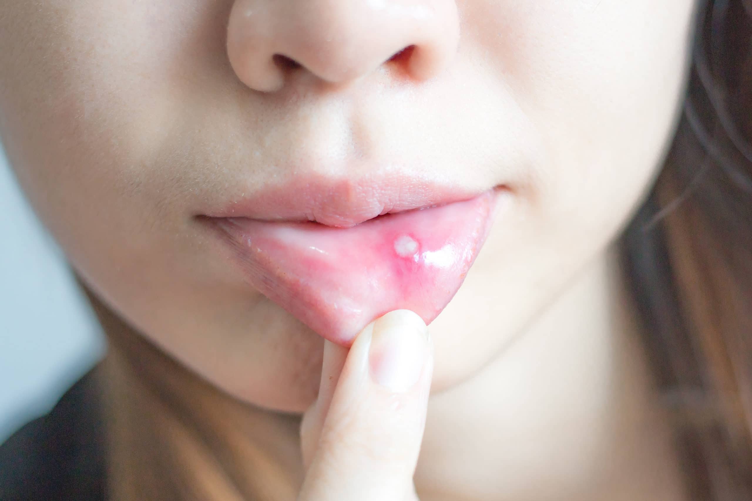 Hinteren zunge bläschen auf der Zungenpilz Ursachen
