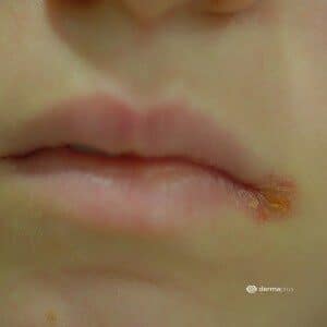 AngulusInfektion linker Mundwinkel angulus infectiosus mundwinkelrhagaden