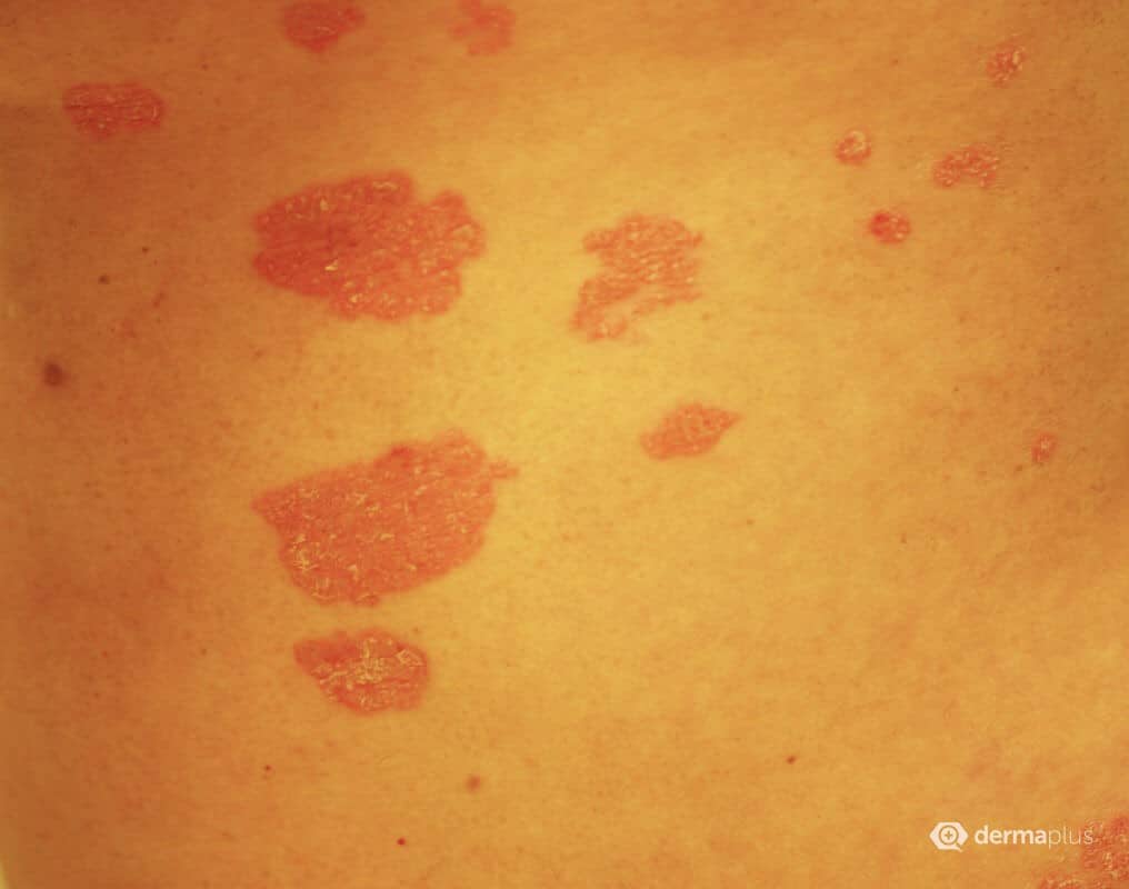 Zusammenhang zwischen Depressionen und Psoriasis derma.plus