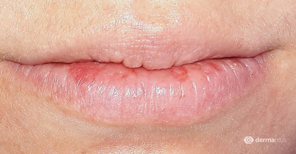 Trockene Lippen: Ursachen und Tipps