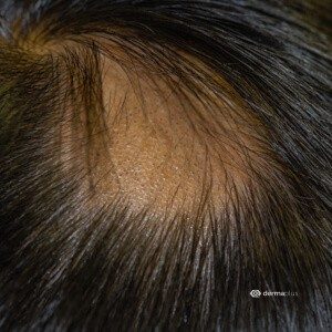 kreisrunder Haarausfall Alopecia areata