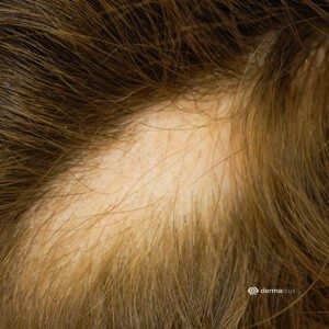 alopecia areata kreisrunder Haarausfall