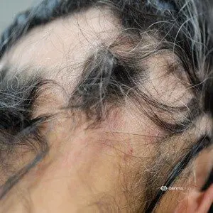 Alopecia areata kreisrunder Haarausfall