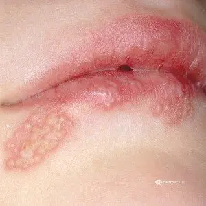 periorale dermatitis Unterlippe mundrose herpes lippenherpes