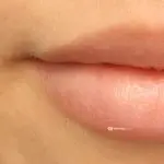trockene Lippen spröde lippen rissige Lippen