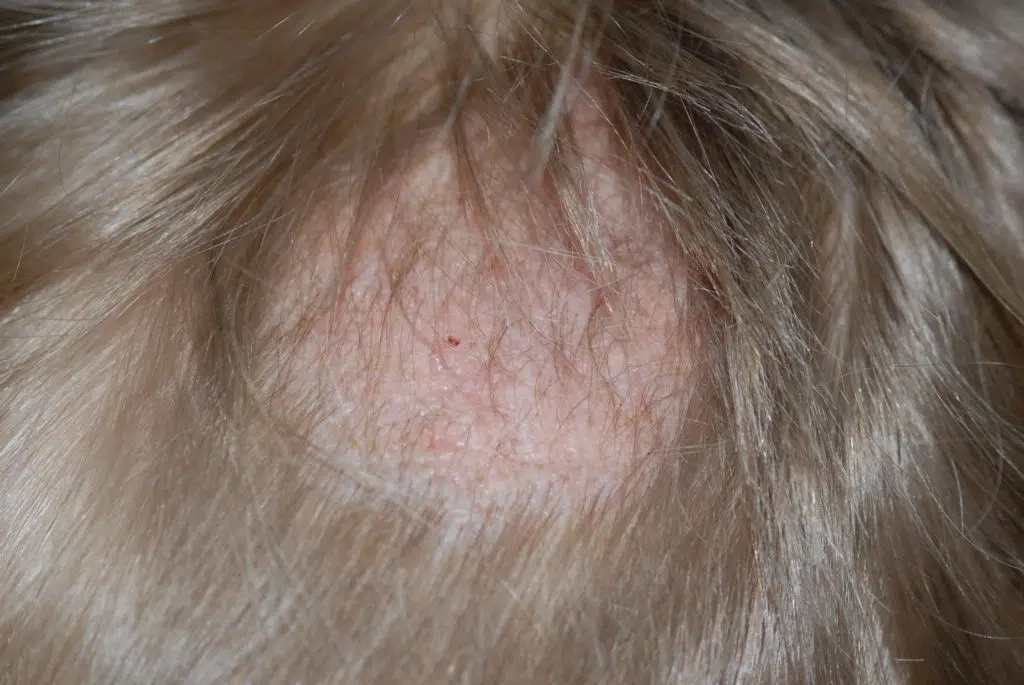 Tinea Capitis - Juckende Kopfhaut, verursacht durch einen Pilz