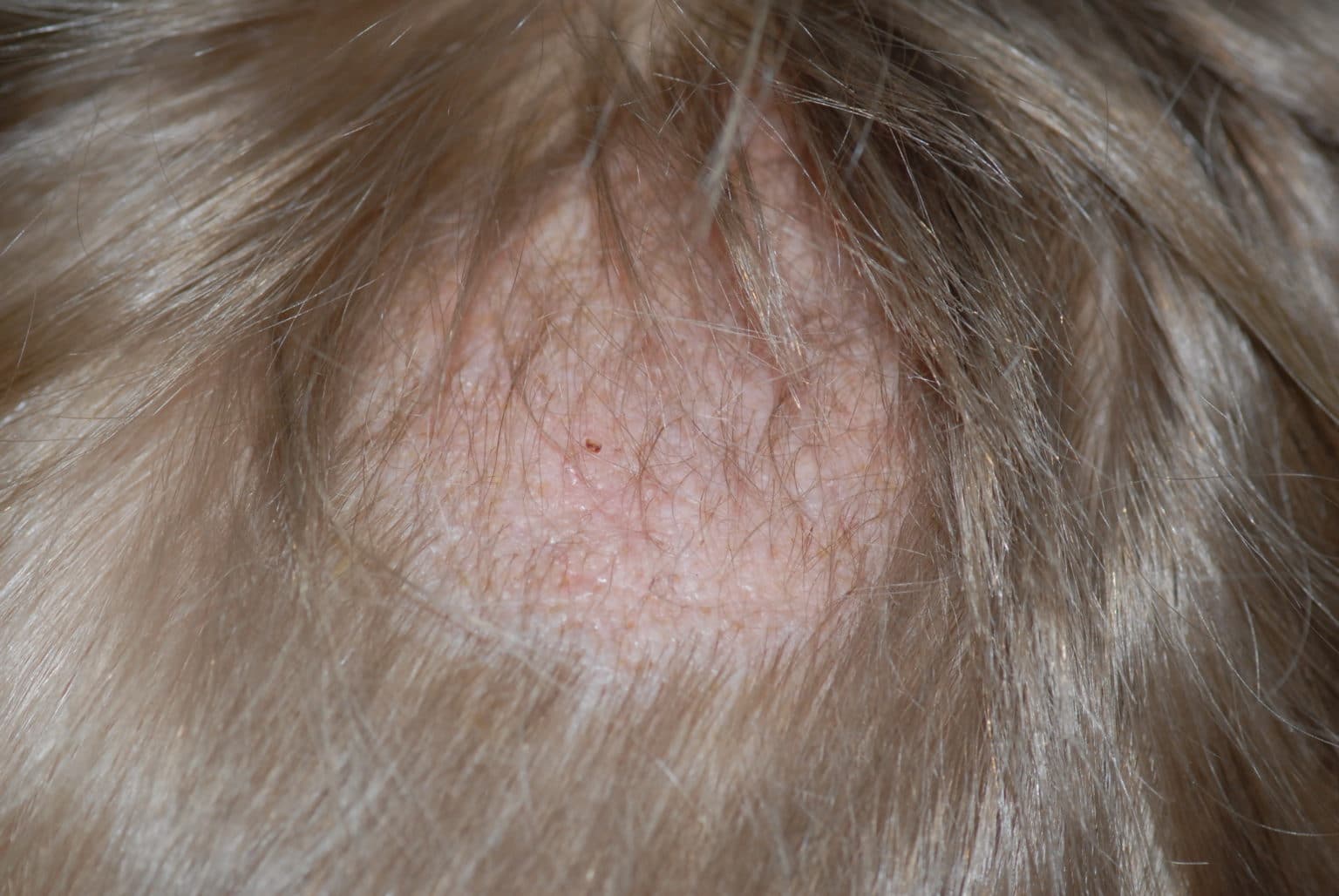 Juckende Kopfhaut: Ursachen und Behandlung | derma.plus