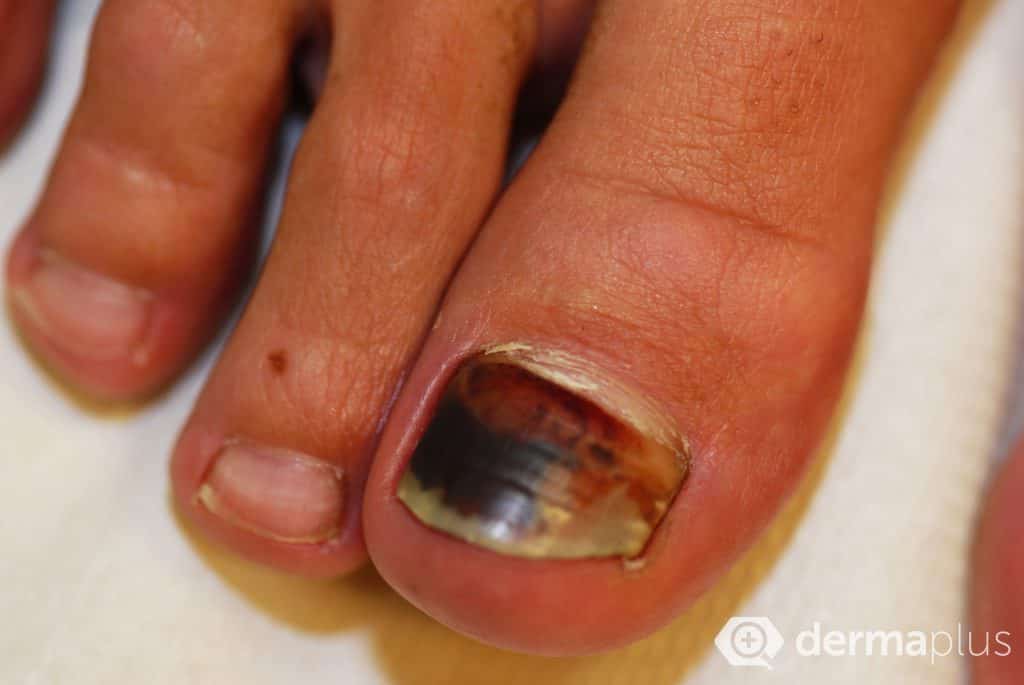 nagelmykose onychomykose nagelpilz