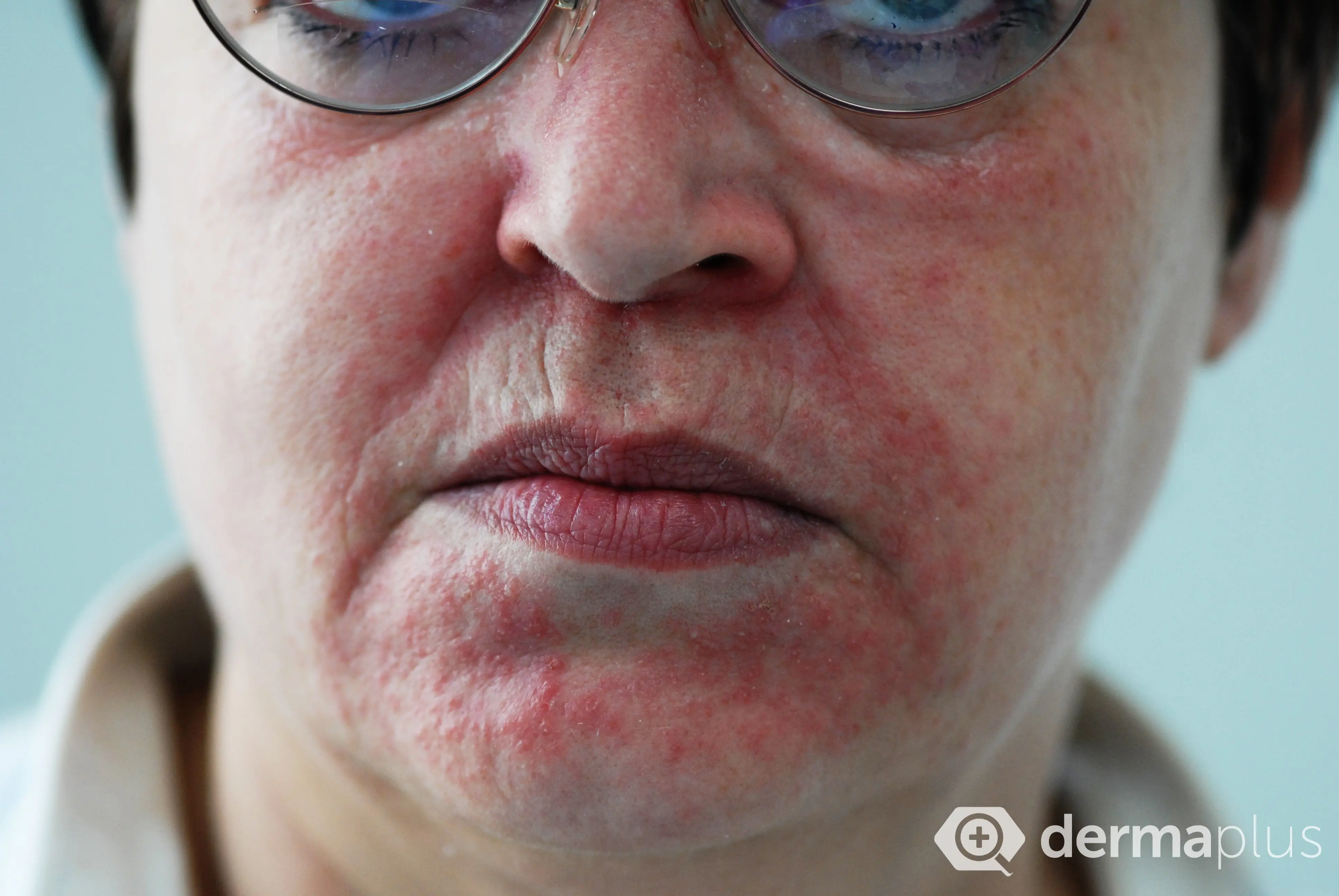 periorale dermatitis roetung Mundrose periorale dermatitis