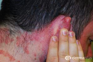 schuppenflechte psoriasis nagel