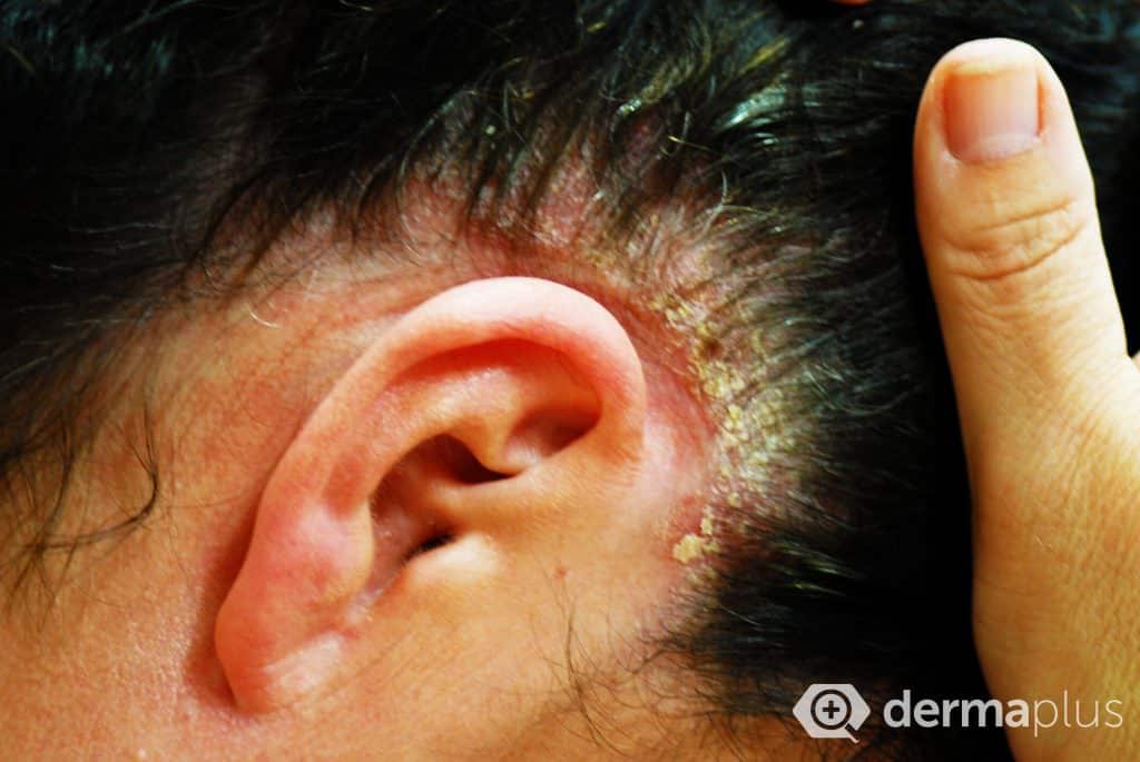 Schuppenflechte (Psoriasis) Ursachen & Therapie derma.plus