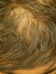androgenetische alopezie