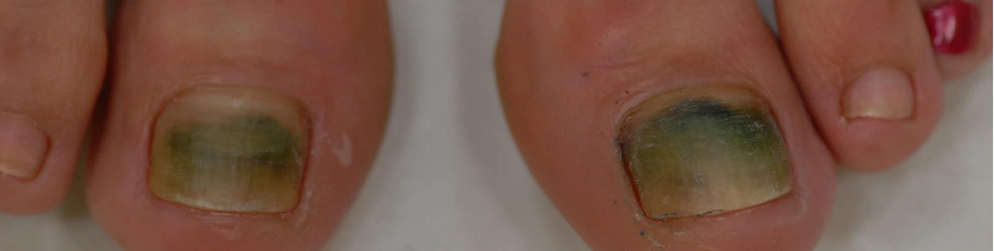 Grüne Nägel (Chloronychie) Ursachen und Therapie derma.plus