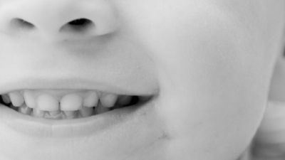 Entzündungen der Mundschleimhaut & Allergien durch Zahnersatz bei Kindern