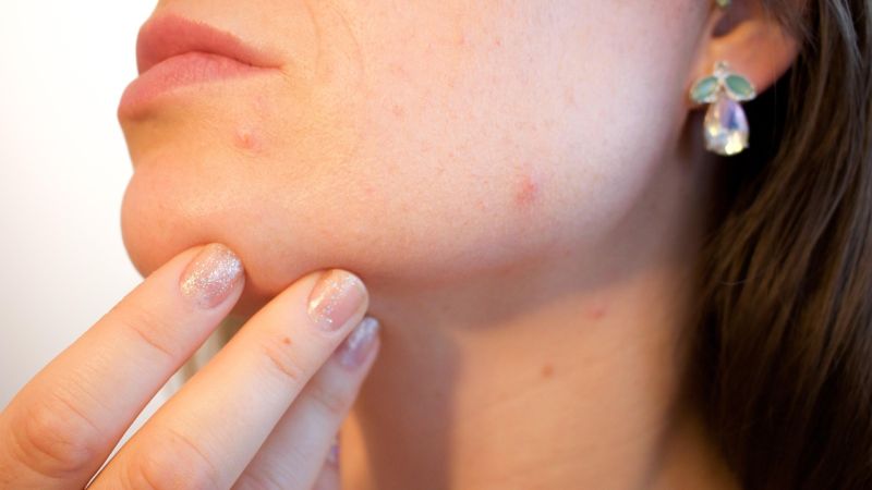One Acne™: Ein ganzheitlicher Ansatz zur Verbesserung der Hautqualität