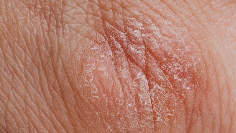 Trockene Haut begünstigt Hautkrankheiten