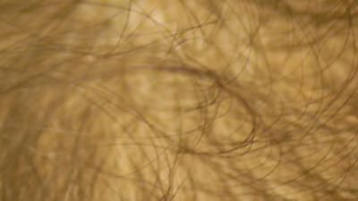 genetisch bedingter Haarausfall (androgenetische Alopezie)