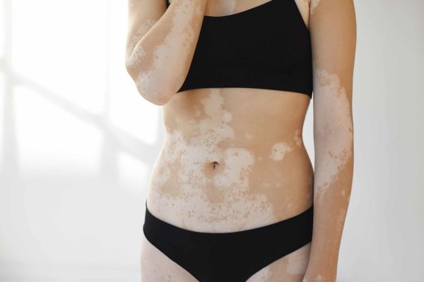 Vitiligo erhöht das Krebsrisiko