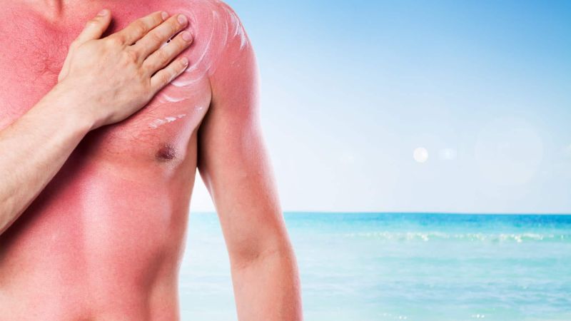 5 Mythen rund um Sonnenschutz