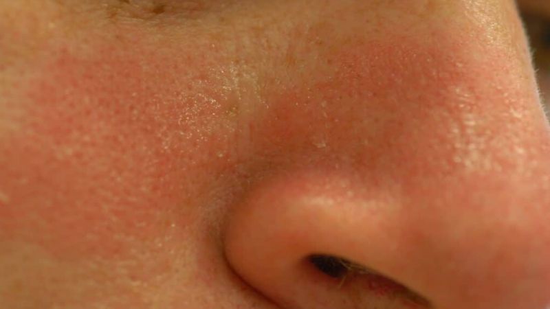 Seborrhoische Dermatitis – Tacrolimus verlängert Symptomfreiheit