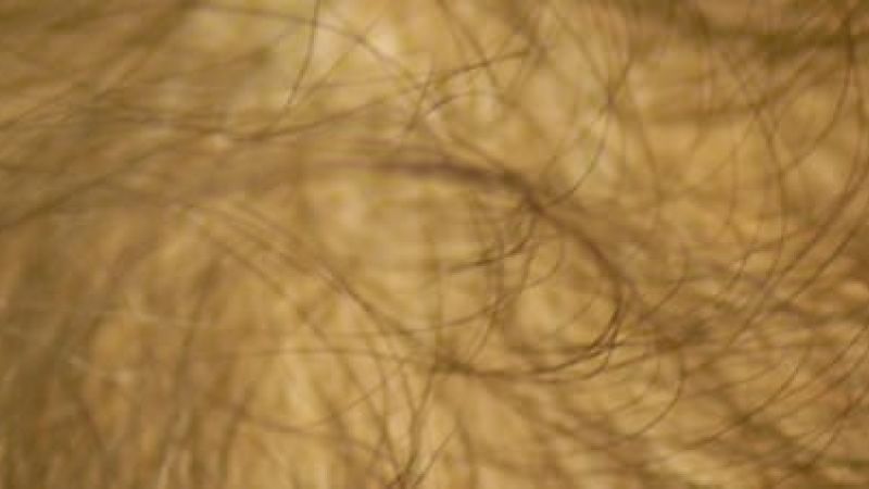 genetisch bedingter Haarausfall (androgenetische Alopezie)