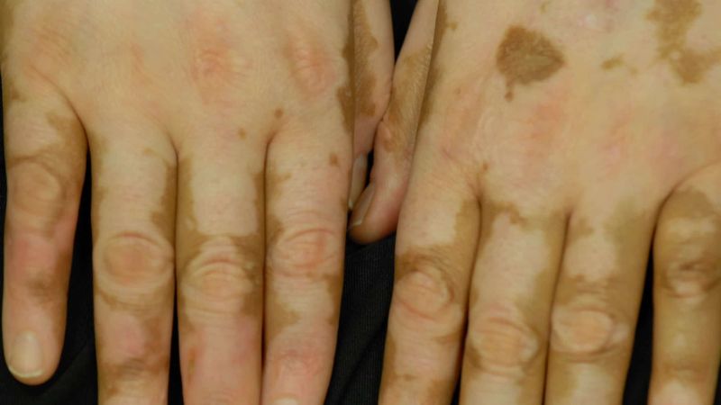 vitiligo finger