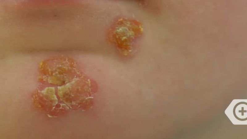 Borkenflechte (Impetigo contagiosa)