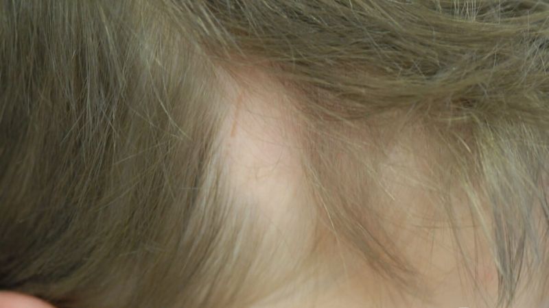 Neue Hoffnung für Patienten mit kreisrundem Haarausfall (Tofacitinib)