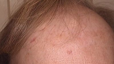 Frontal fibrosierende Alopezie