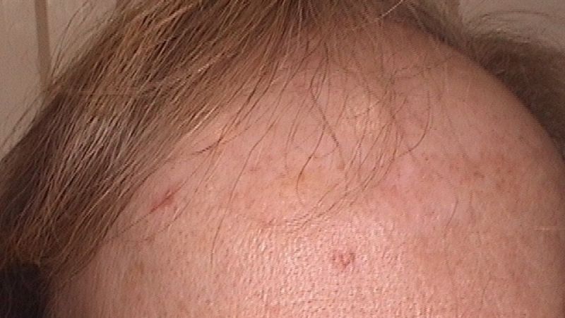 Frontal fibrosierende Alopezie: Sonnenschutzprodukte sind vermutlich kein Auslöser